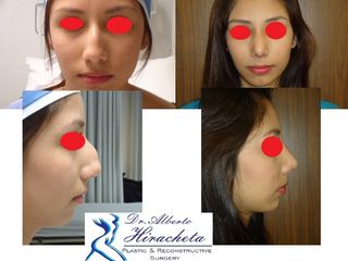 Antes y después de Rinoplastia
