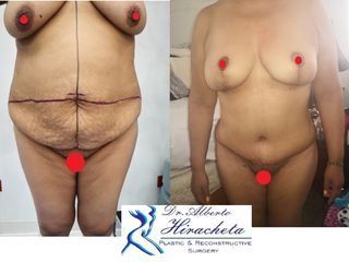 Antes y después de Mommy Makeover