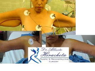 Antes y después de Braquioplastia