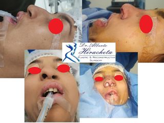 Antes y después de Rinoplastia