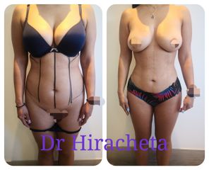 Antes y después de Lipoescultura