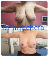 Antes y después de Mastopexia