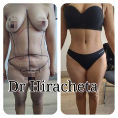Antes y después de Abdominoplastia
