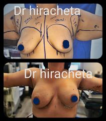 Antes y después de Braquioplastia
