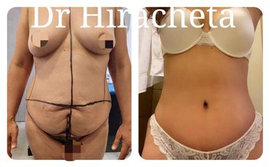 Antes y después de Abdominoplastia