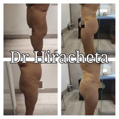 Antes y después de Gluteoplastia con grasa