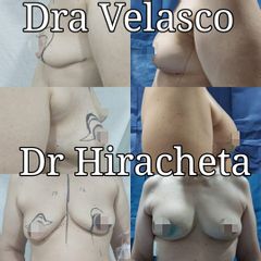 Antes y después de Mastectomia con preservación de pezón