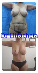 Antes y después de Mommy makeover
