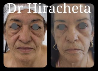 Antes y después de Blefaroplastia