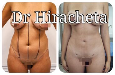Antes y después de Liposucción