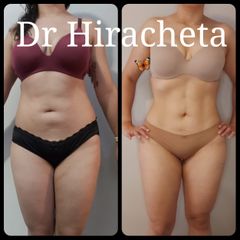 Antes y después de Lipoescultura con Renuvion