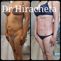 Antes y después de Lipo jplasma