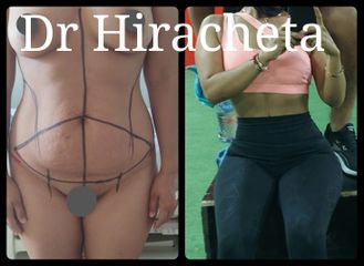Antes y después de Abdominoplastia