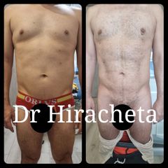 Antes y después de Liposucción