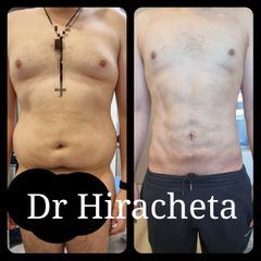 Antes y después de Lipo hombre jplasma