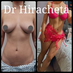 Antes y después de Lipoescultura
