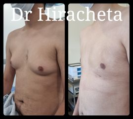Antes y después de Ginecomasti