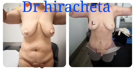 Antes y después de Mommy makeover