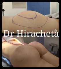 Antes y después de Gluteoplastia 