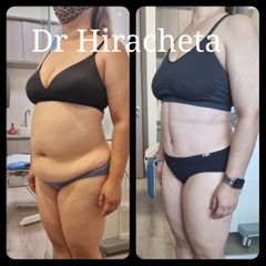 Abdominoplastia - Dr. Alberto Hiracheta