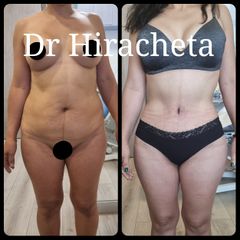 Abdominoplastia - Dr. Alberto Hiracheta