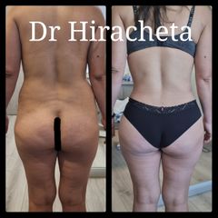 Gluteoplastia - Dr. Alberto Hiracheta