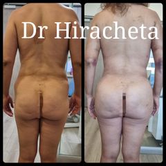 Gluteoplastia - Dr. Alberto Hiracheta