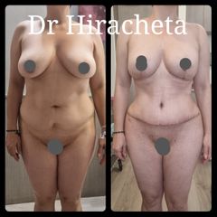 Mommy makeover - Dr. Alberto Hiracheta