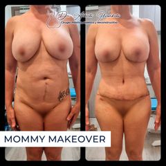 Mommy makeover - Dr. Alberto Hiracheta
