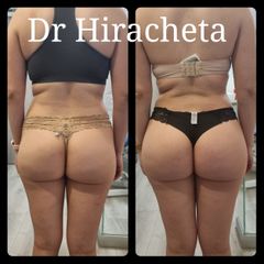 Gluteoplastia - Dr. Alberto Hiracheta