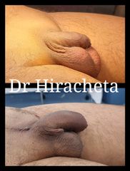 Engreosamiento de pene - Dr. Alberto Hiracheta