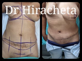 Cirugía para cicatrices - Dr. Alberto Hiracheta