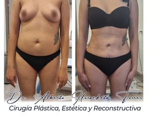 Lipo