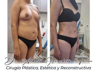 Lipo lado