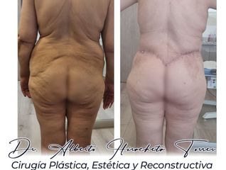 Lifting glúteo