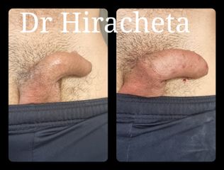 Aumento de pene - Dr. Alberto Hiracheta