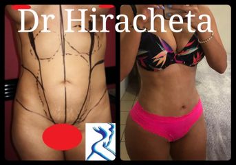 Lipoescultura - Dr. Alberto Hiracheta