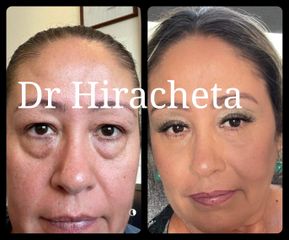 Blefaroplastia - Dr. Alberto Hiracheta