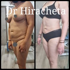 Radiofrecuencia - Dr. Alberto Hiracheta