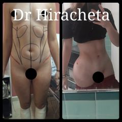 Liposucción - Dr. Alberto Hiracheta