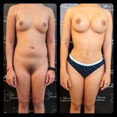 Mommy makeover - Dr. Alberto Hiracheta