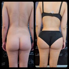 Gluteoplastia - Dr. Alberto Hiracheta