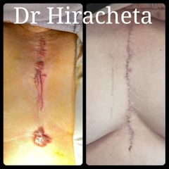 Queloide - Dr. Alberto Hiracheta