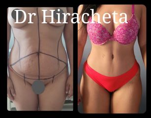 Abdominoplastia - Dr. Alberto Hiracheta