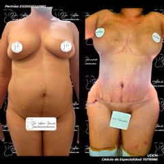 Abdominoplastia - Dr. Alberto Hiracheta