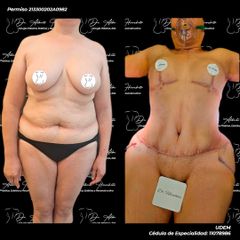 Mommy makeover - Dr. Alberto Hiracheta