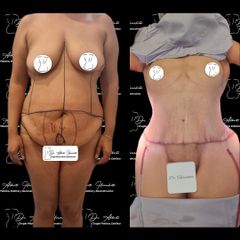 Abdominoplastia - Dr. Alberto Hiracheta