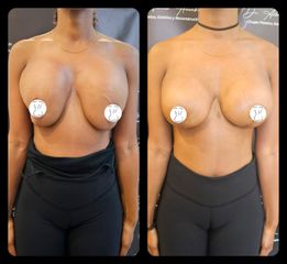 Mastopexia - Dr. Alberto Hiracheta