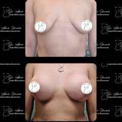 Mastopexia - Dr. Alberto Hiracheta