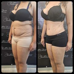 Abdominoplastia - Dr. Alberto Hiracheta